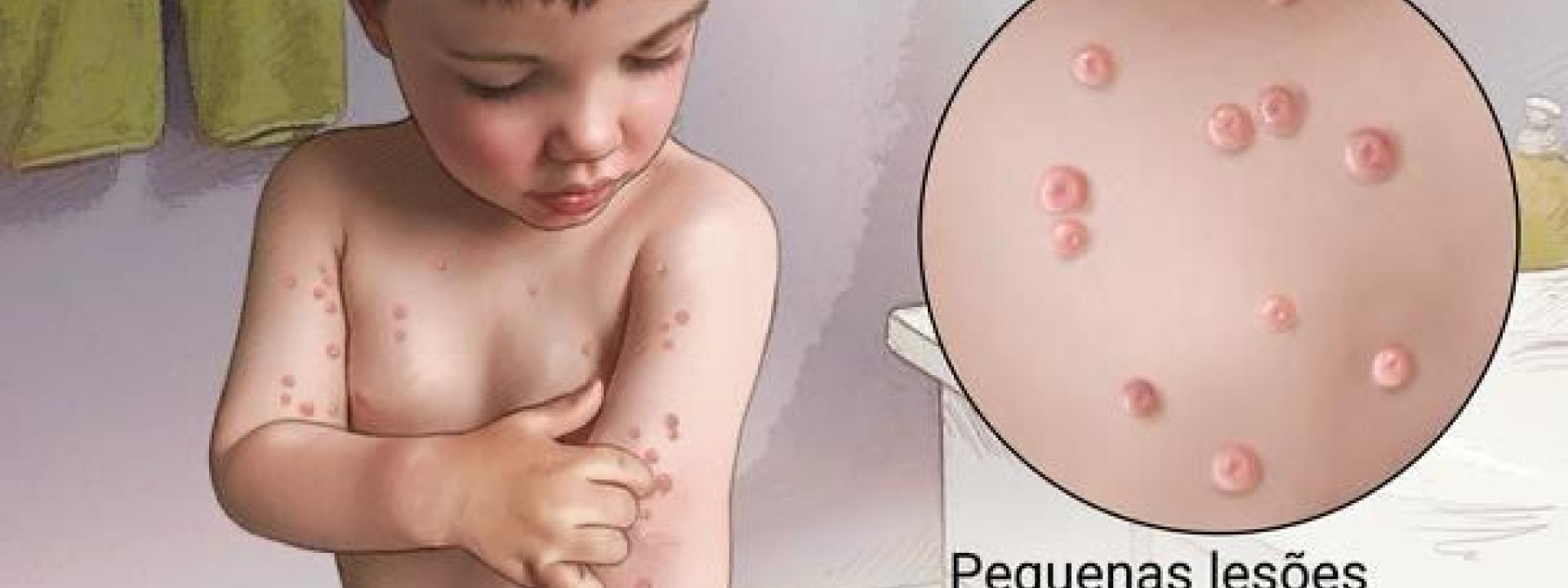 Bolinhas no corpo: molusco contagioso?