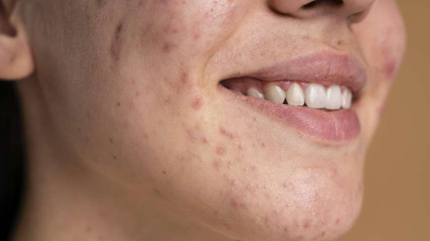 Mitos e Verdades Sobre a Acne