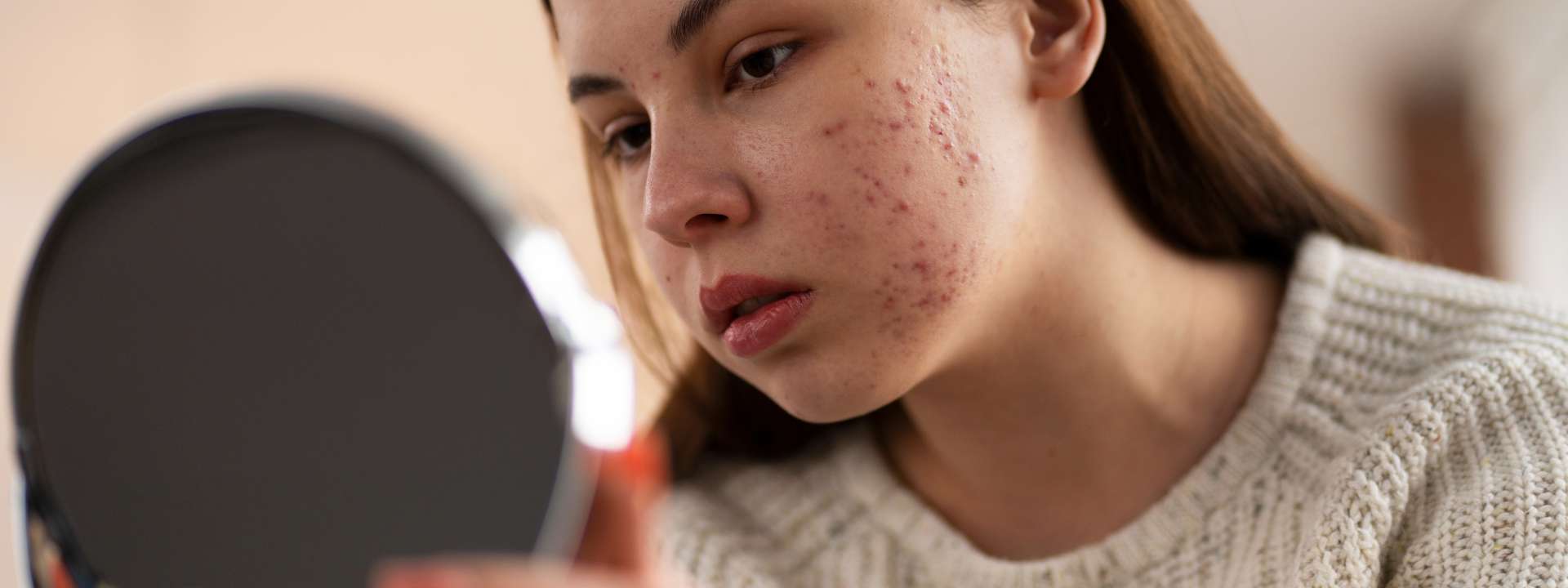 Acne e Roacutan®