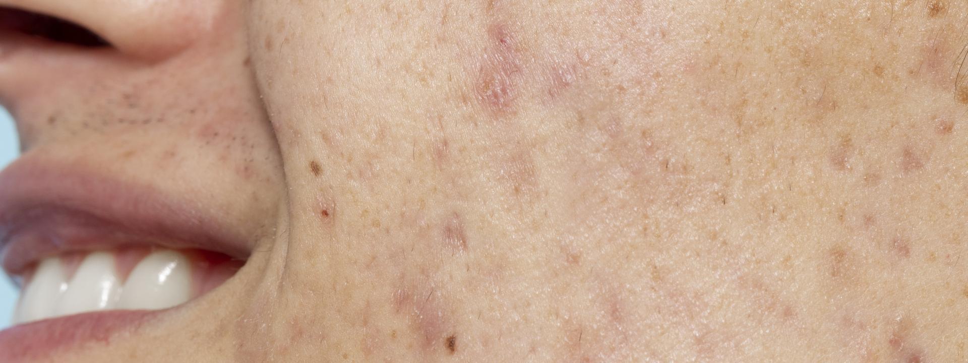Cicatriz de acne tem solução ?