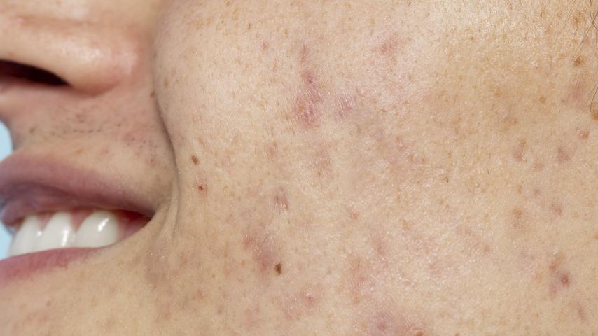 Cicatriz de acne tem solução ?