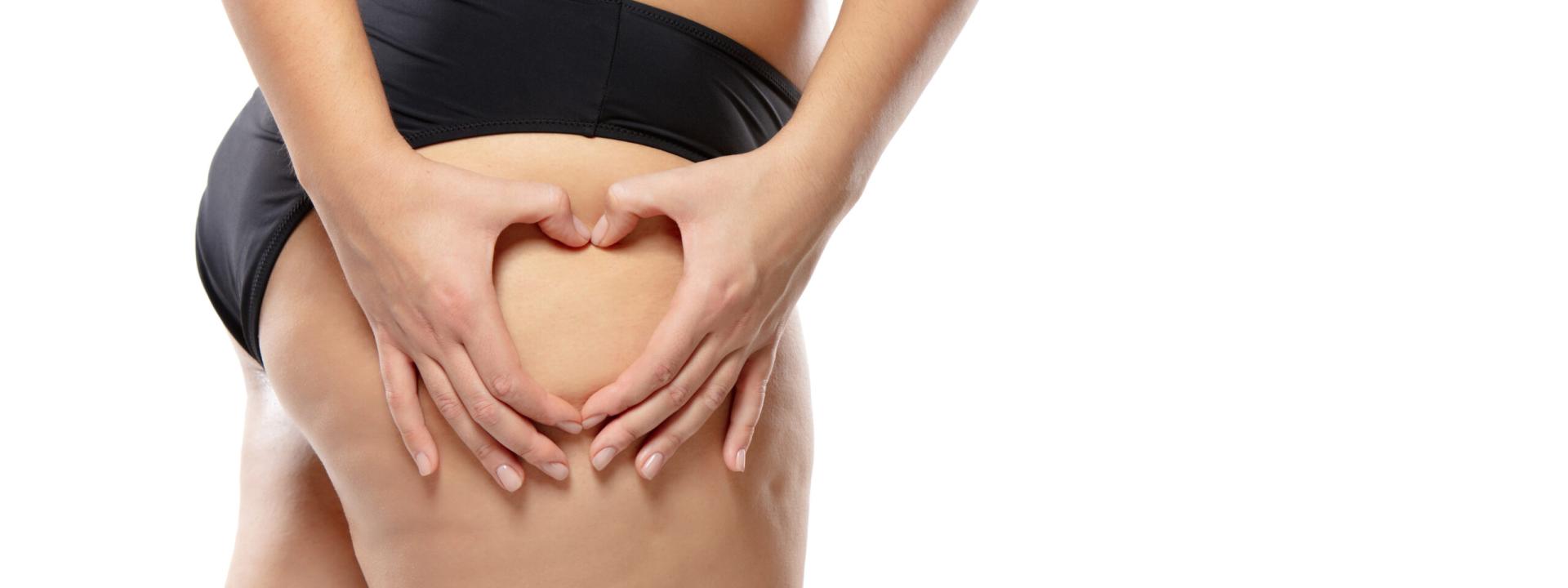 Celulite profunda no glúteo e pernas