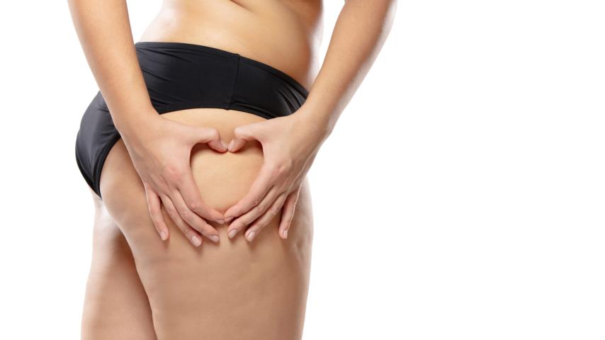 Celulite profunda no glúteo e pernas